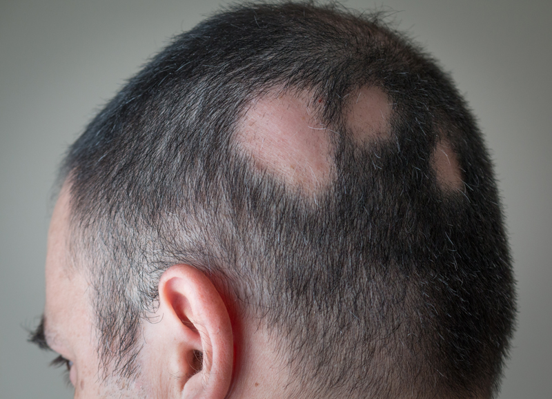 Alopecia Aerata - plek kaalheid